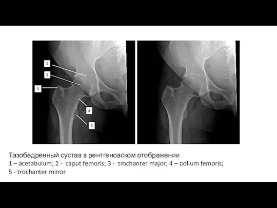 Тазобедренный сустав в рентгеновском отображении 1 – acetabulum; 2 - caput femoris; 3