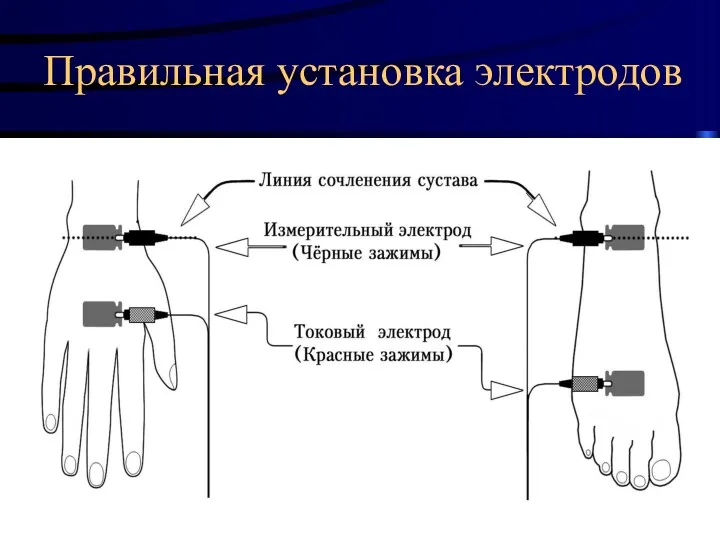 * Правильная установка электродов