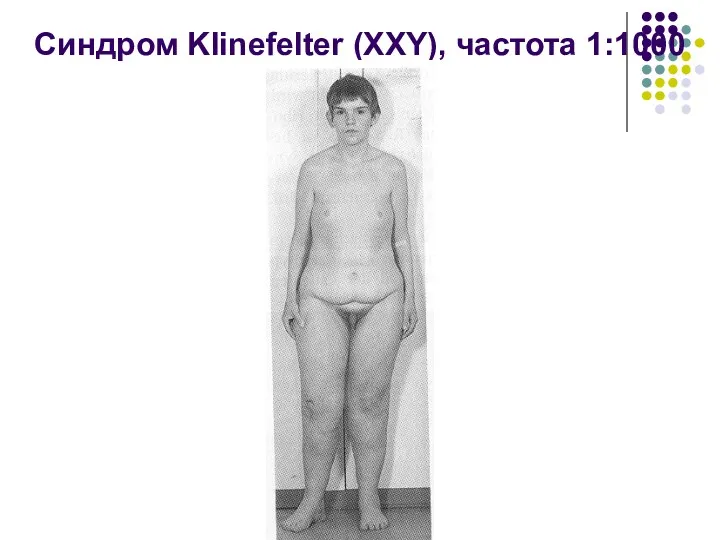 Синдром Klinefelter (XXY), частота 1:1000
