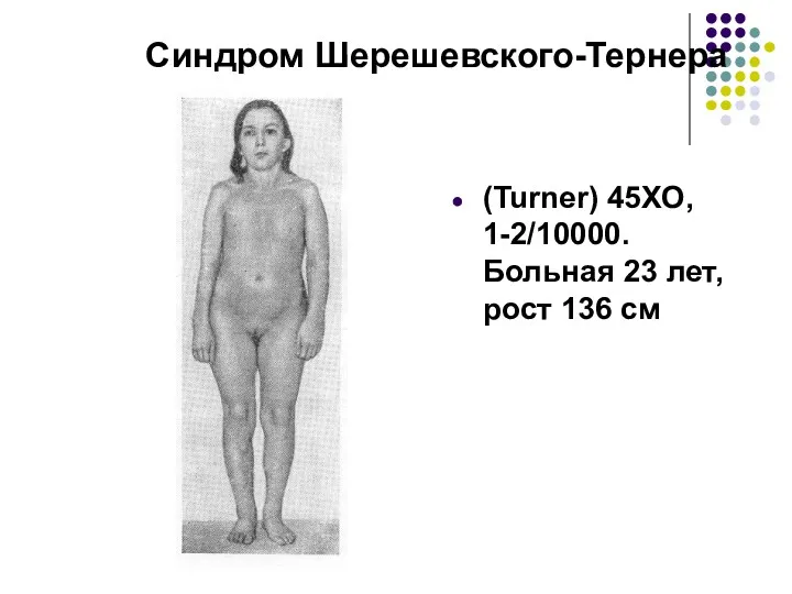 Синдром Шерешевского-Тернера (Turner) 45ХО, 1-2/10000. Больная 23 лет, рост 136 см