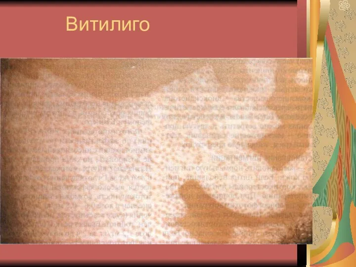 Витилиго