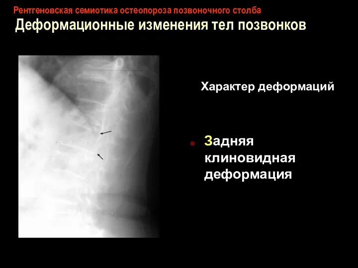 Рентгеновская семиотика остеопороза позвоночного столба Деформационные изменения тел позвонков Характер деформаций Задняя клиновидная деформация