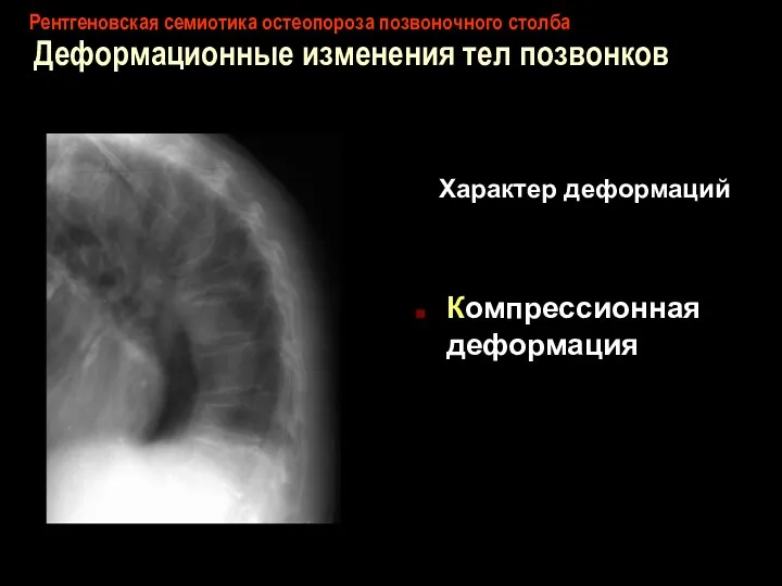 Рентгеновская семиотика остеопороза позвоночного столба Деформационные изменения тел позвонков Характер деформаций Компрессионная деформация