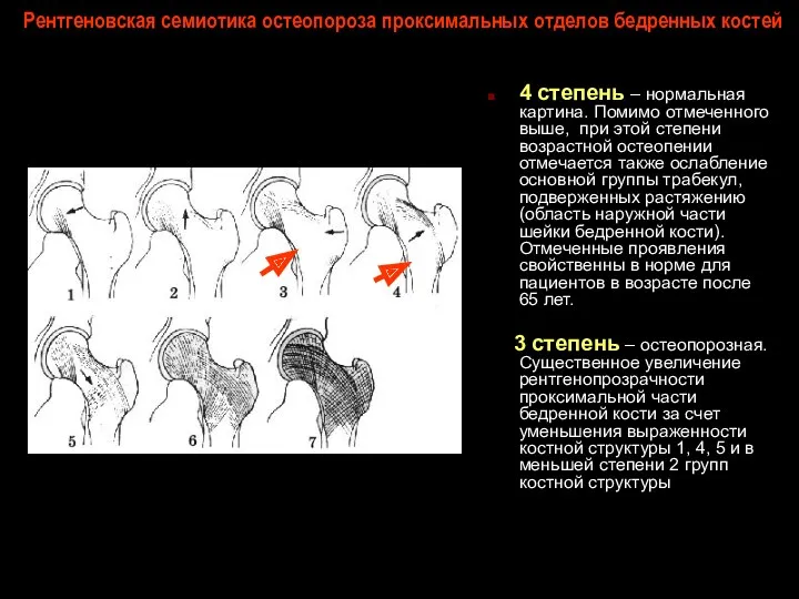 Рентгеновская семиотика остеопороза проксимальных отделов бедренных костей 4 степень –