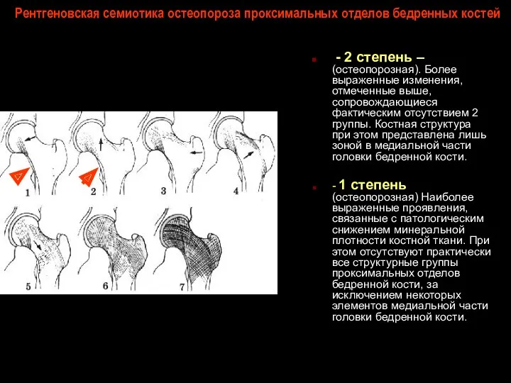 Рентгеновская семиотика остеопороза проксимальных отделов бедренных костей - 2 степень