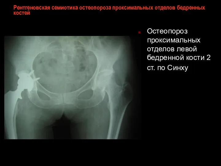 Рентгеновская семиотика остеопороза проксимальных отделов бедренных костей Остеопороз проксимальных отделов