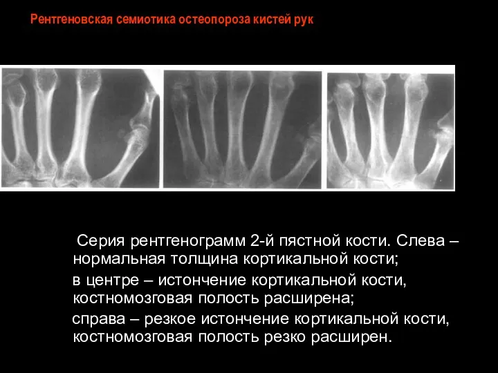 Рентгеновская семиотика остеопороза кистей рук Серия рентгенограмм 2-й пястной кости.