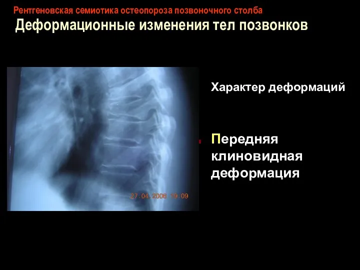 Рентгеновская семиотика остеопороза позвоночного столба Деформационные изменения тел позвонков Характер деформаций Передняя клиновидная деформация