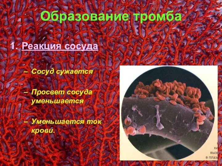 Образование тромба Реакция сосуда Сосуд сужается Просвет сосуда уменьшается Уменьшается ток крови.