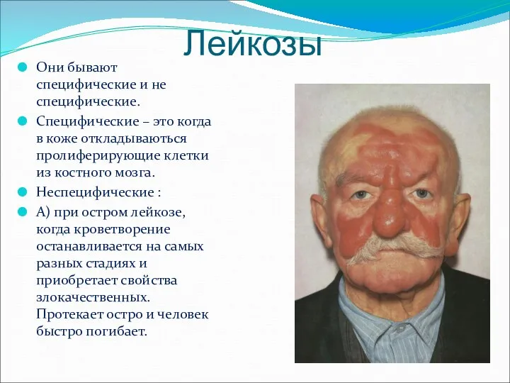 Лейкозы Они бывают специфические и не специфические. Специфические – это