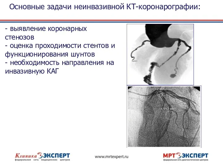 Основные задачи неинвазивной КТ-коронарографии: - выявление коронарных стенозов - оценка