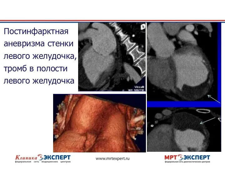Постинфарктная аневризма стенки левого желудочка, тромб в полости левого желудочка