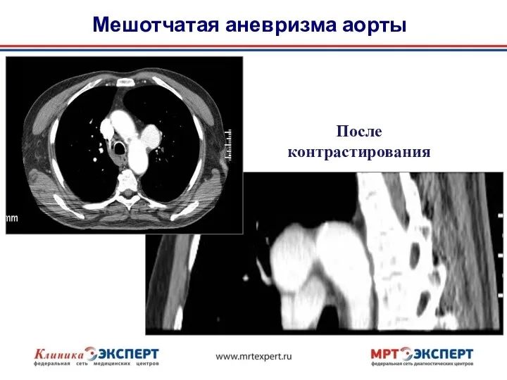 Мешотчатая аневризма аорты После контрастирования