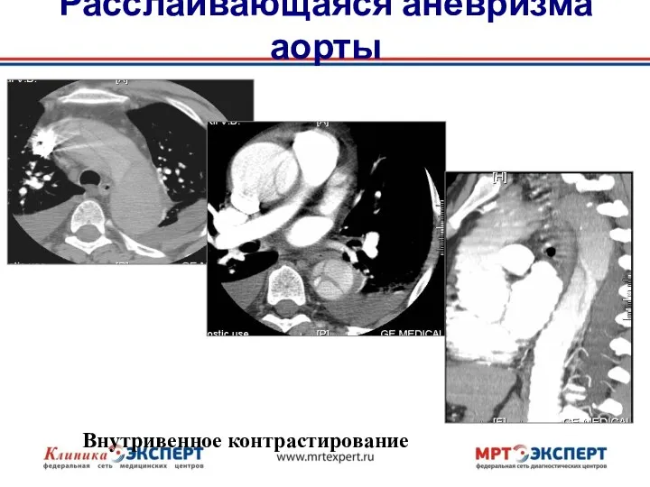 Расслаивающаяся аневризма аорты Внутривенное контрастирование