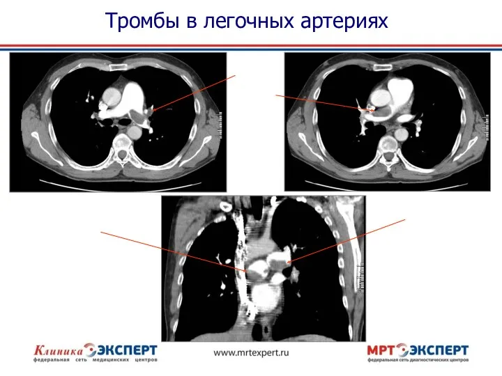 Тромбы в легочных артериях