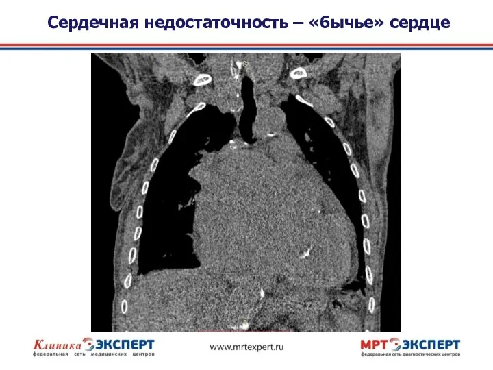 Сердечная недостаточность – «бычье» сердце