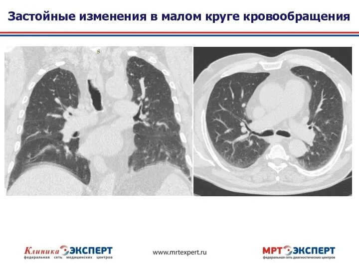 Застойные изменения в малом круге кровообращения