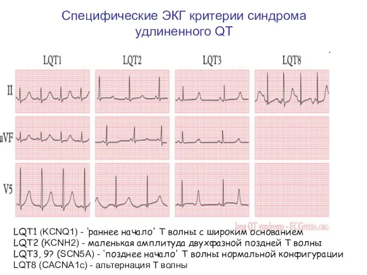 Специфические ЭКГ критерии синдрома удлиненного QT LQT1 (KCNQ1) - ‘раннее