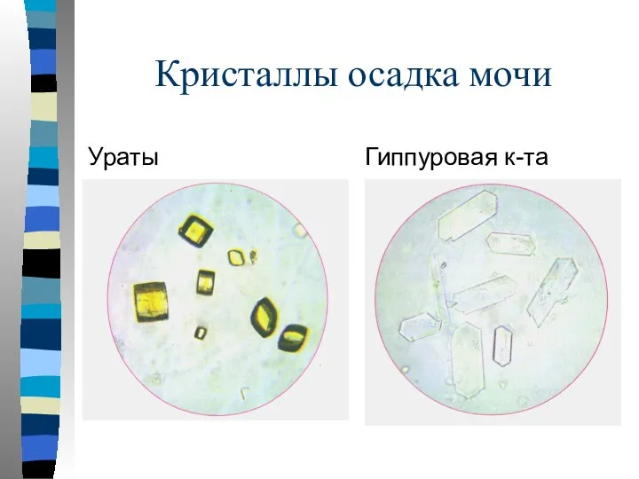 Кристаллы осадка мочи Ураты Гиппуровая к-та