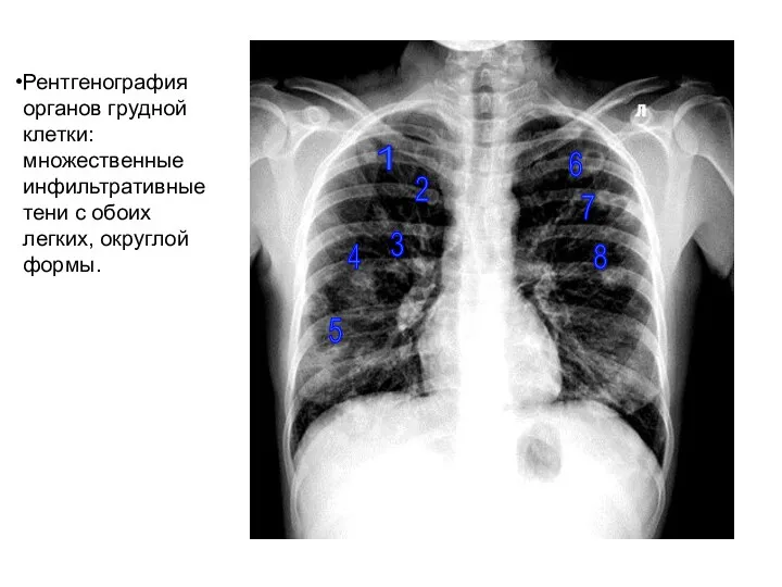 Рентгенография органов грудной клетки: множественные инфильтративные тени с обоих легких,