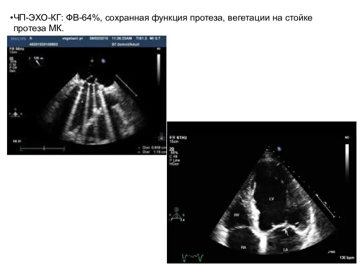 ЧП-ЭХО-КГ: ФВ-64%, сохранная функция протеза, вегетации на стойке протеза МК.