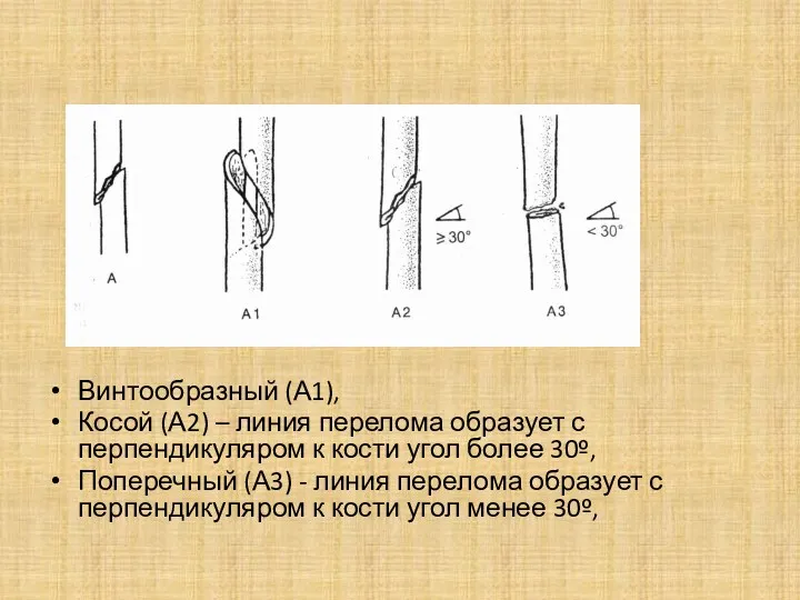 Винтообразный (А1), Косой (А2) – линия перелома образует с перпендикуляром