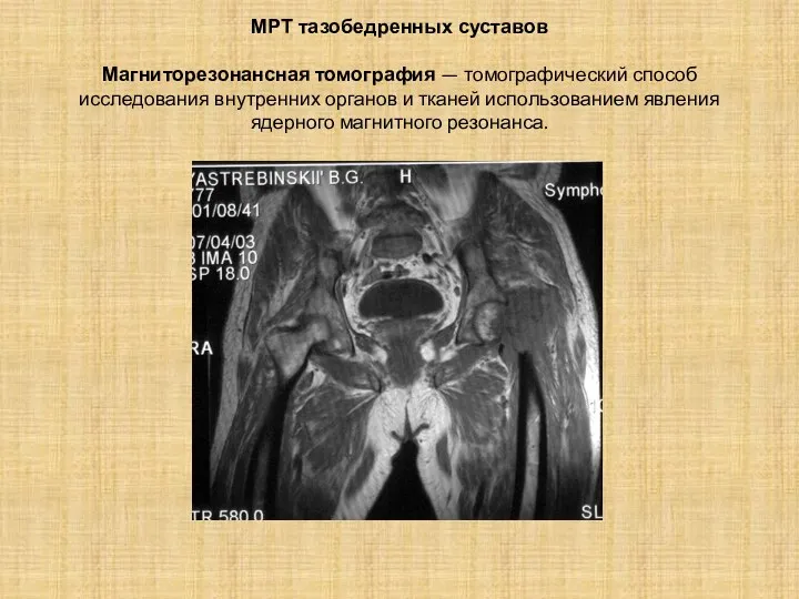 МРТ тазобедренных суставов Магниторезонансная томография — томографический способ исследования внутренних