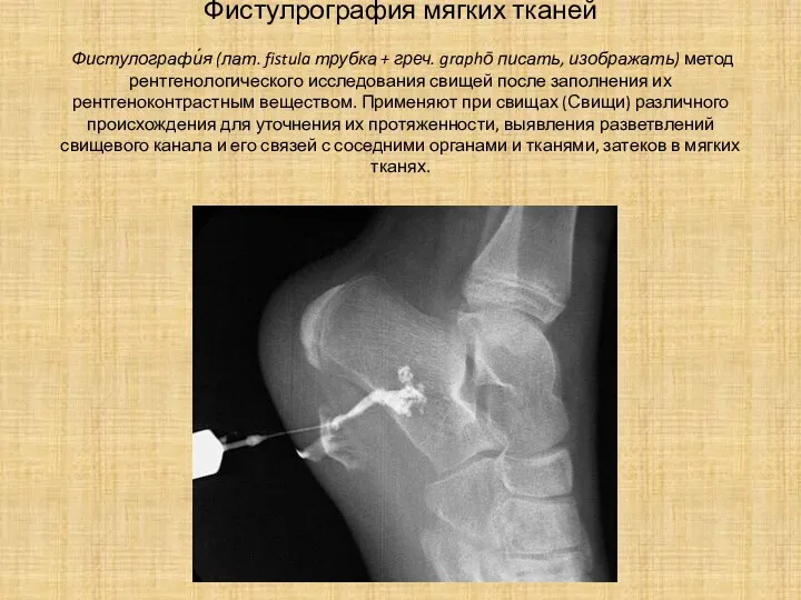 Фистулрография мягких тканей Фистулографи́я (лат. fistula трубка + греч. graphō