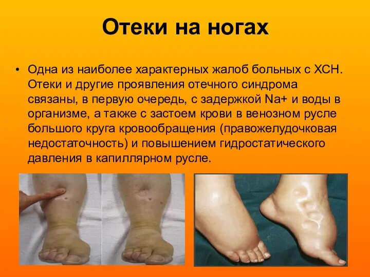 Отеки на ногах Одна из наиболее характерных жалоб больных с ХСН. Отеки и