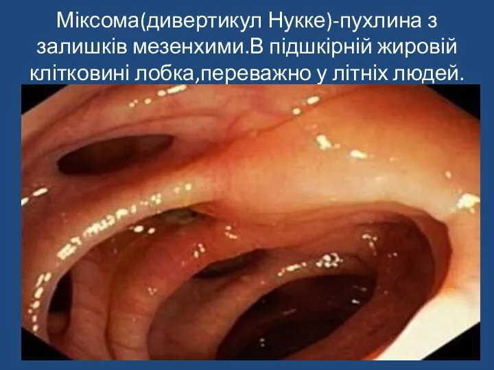 Міксома(дивертикул Нукке)-пухлина з залишків мезенхими.В підшкірній жировій клітковині лобка,переважно у літніх людей.