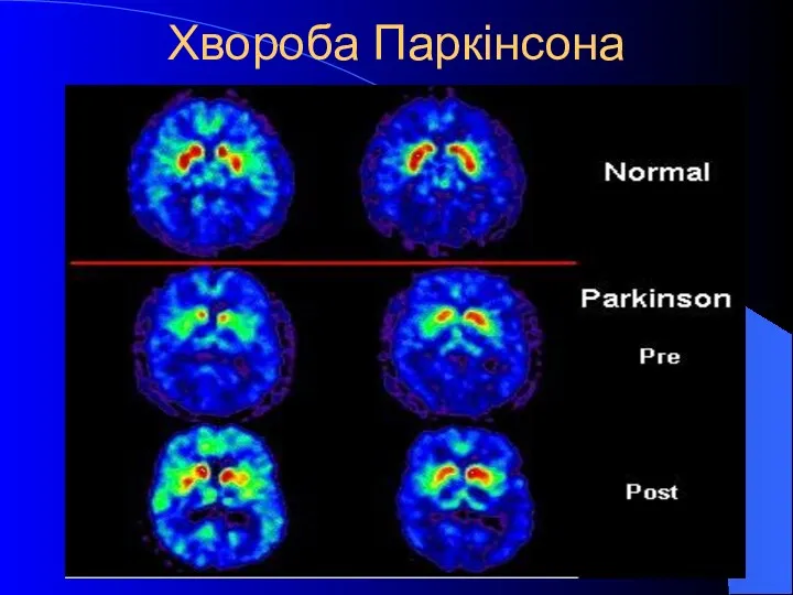 Хвороба Паркінсона