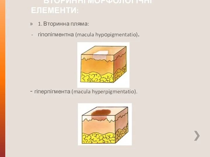 ВТОРИННІ МОРФОЛОГІЧНІ ЕЛЕМЕНТИ: 1. Вторинна пляма: гіпопігментна (macula hypоpigmentatio). - гіперпігмента (macula hyperpigmentatio).