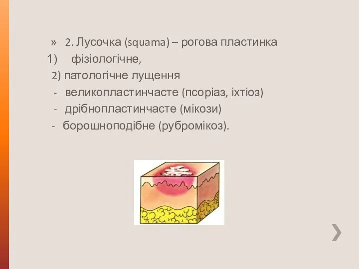 2. Лусочка (squama) – рогова пластинка фізіологічне, 2) патологічне лущення великопластинчасте (псоріаз, іхтіоз)