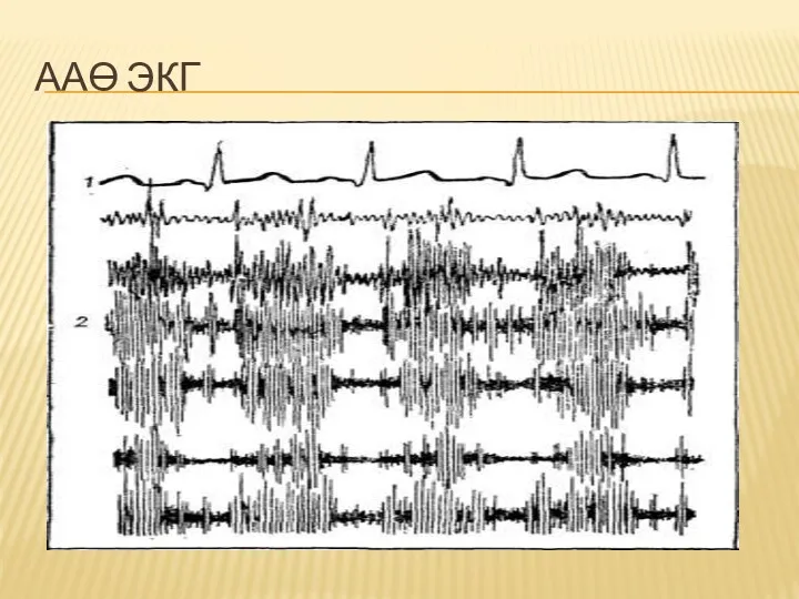 ААӨ ЭКГ
