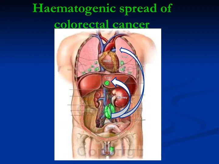 Haematogenic spread of colorectal cancer