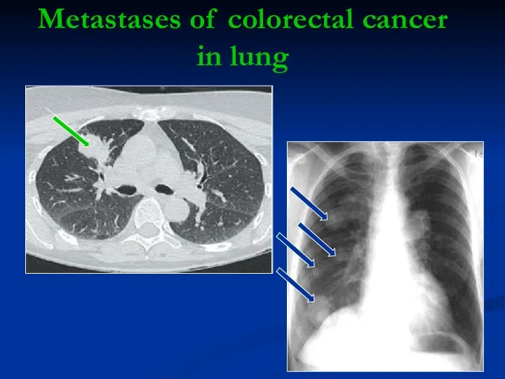 Metastases of colorectal cancer in lung