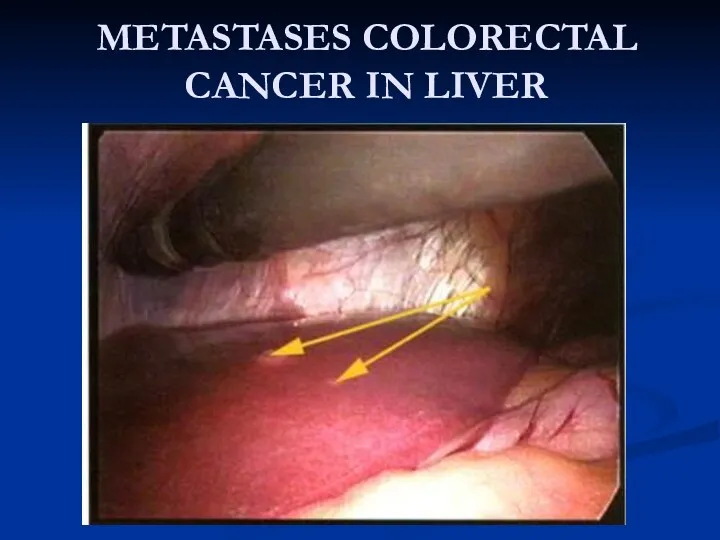 METASTASES COLORECTAL CANCER IN LIVER