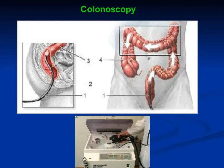 Colonoscopy