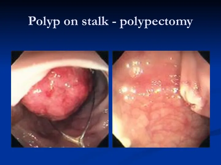 Polyp on stalk - polypectomy