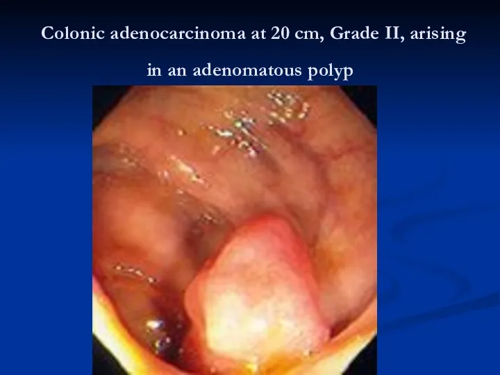 Colonic adenocarcinoma at 20 cm, Grade II, arising in an adenomatous polyp