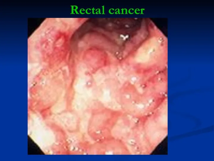 Rectal cancer