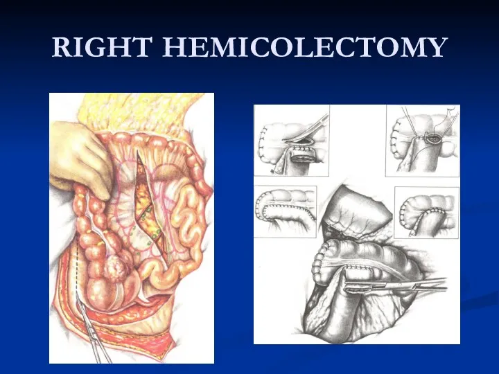 RIGHT HEMICOLECTOMY