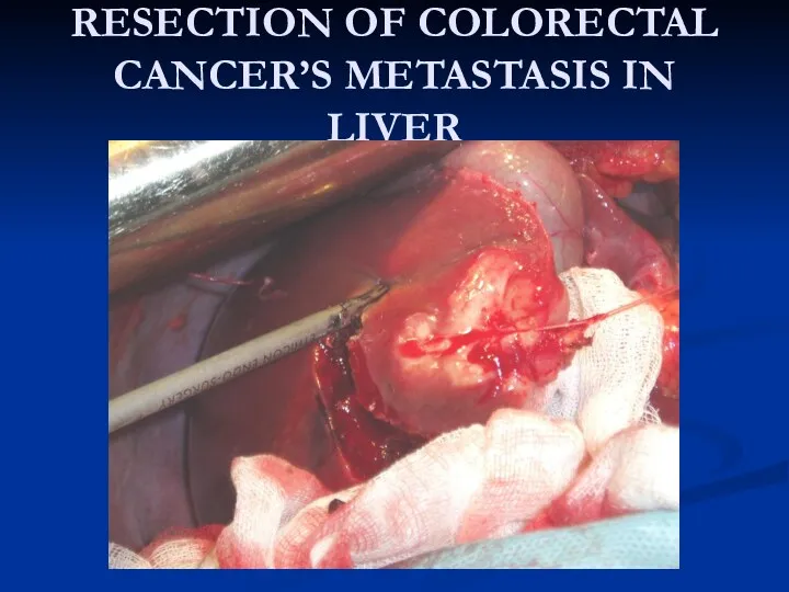 RESECTION OF COLORECTAL CANCER’S METASTASIS IN LIVER