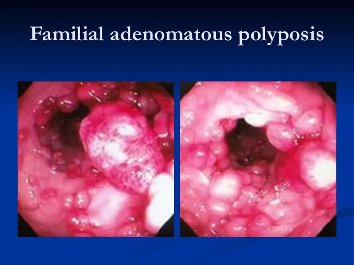 Familial adenomatous polyposis