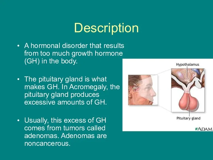 Description A hormonal disorder that results from too much growth