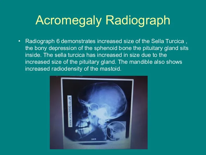 Acromegaly Radiograph Radiograph 6 demonstrates increased size of the Sella