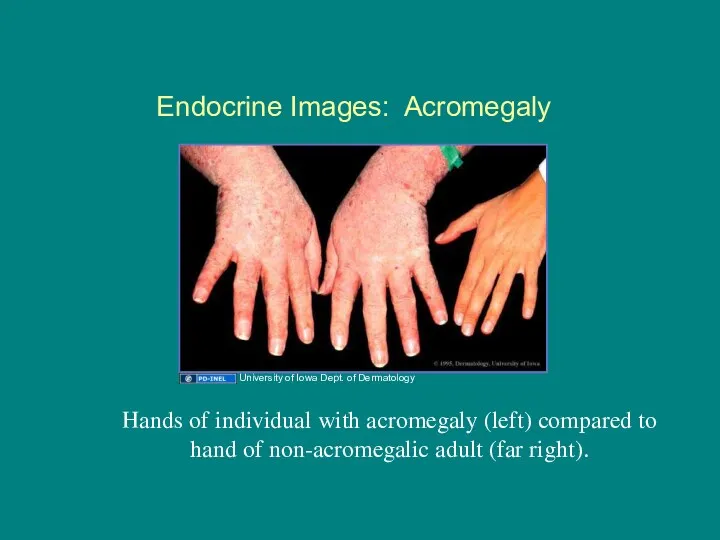 Endocrine Images: Acromegaly Hands of individual with acromegaly (left) compared