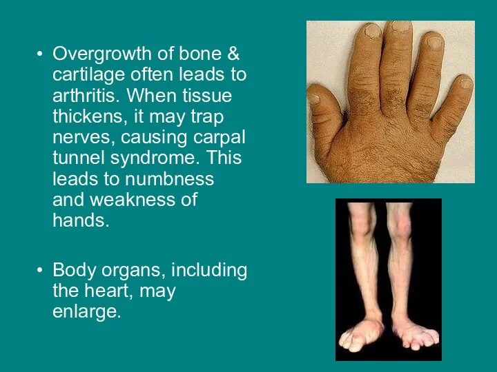 Overgrowth of bone & cartilage often leads to arthritis. When