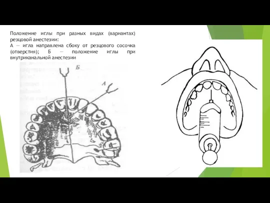Положение иглы при разных видах (вариантах) резцовой анестезии: А —