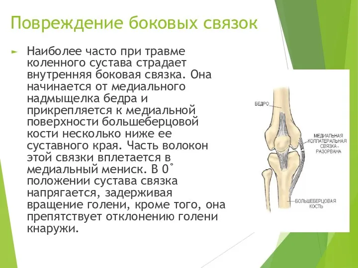 Повреждение боковых связок Наиболее часто при травме коленного сустава страдает внутренняя боковая связка.